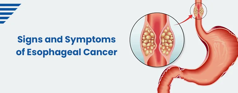 Signs and Symptoms of Esophageal Cancer You Shouldn't Ignore