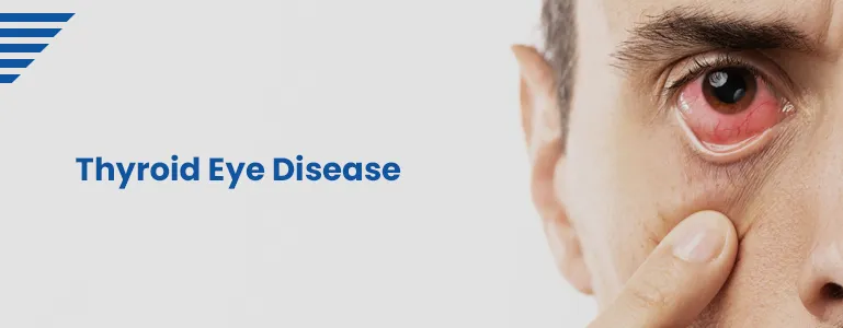 Thyroid Eye Disease
