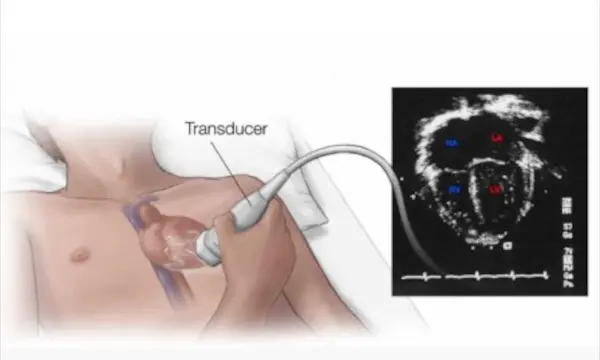 A person undergoing 2d echo test