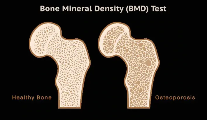 Bone mineral density test (for dense bones)