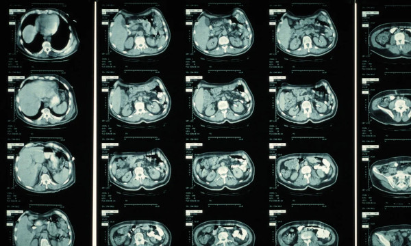 CT Scan