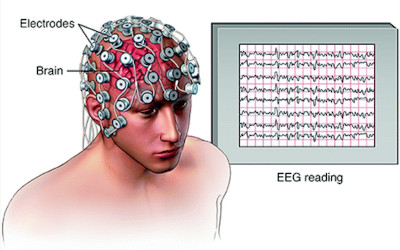 Electroencephalography (EEG)