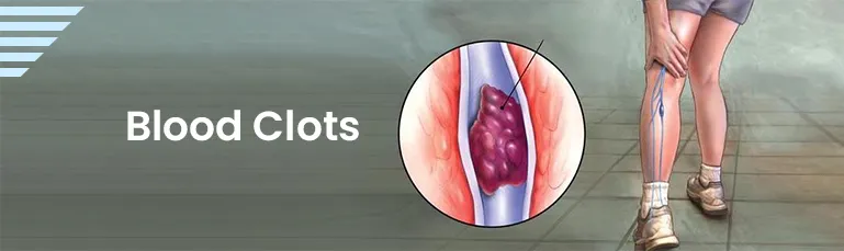 Blood Clots