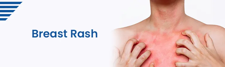 Test for Breast Rash Symptom  Sprint Diagnostics Hyderabad