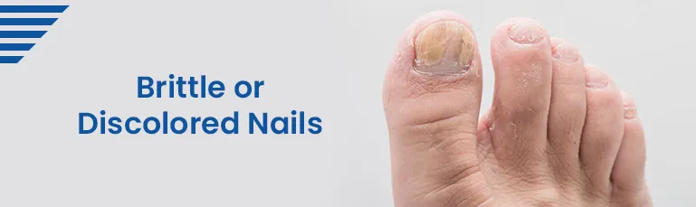 Brittle or Discolored Nails