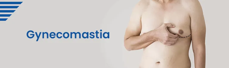 Gynecomastia