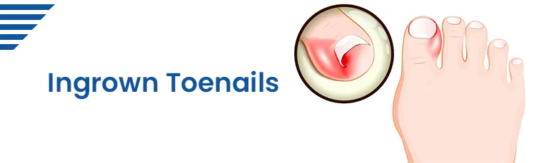 Ingrown Toenails Wetherby | Nail Surgery - Stray Podiatry & Chiropody