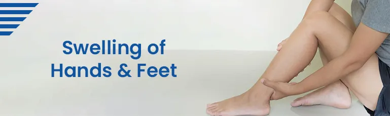 Swelling of Hands and Feet