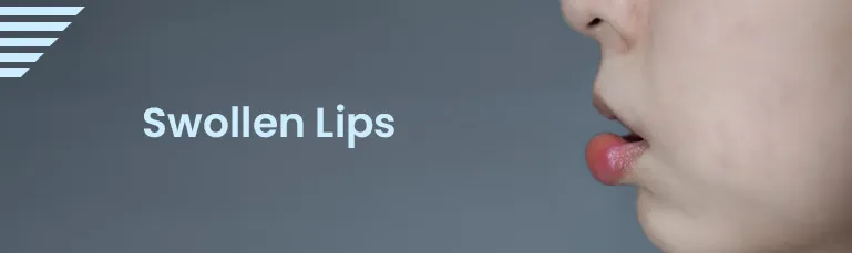Swollen Lips